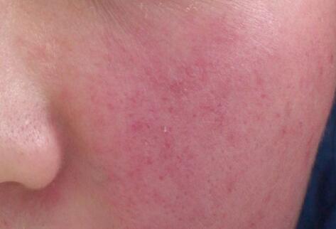 如何拯救你的敏感肌？廣西南寧美容培訓(xùn)叫你正確方法