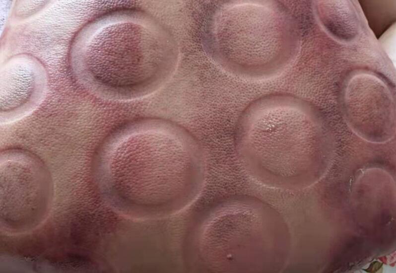 拔火罐有什么用？廣西美容職業(yè)培訓(xùn)學(xué)校演示給你看