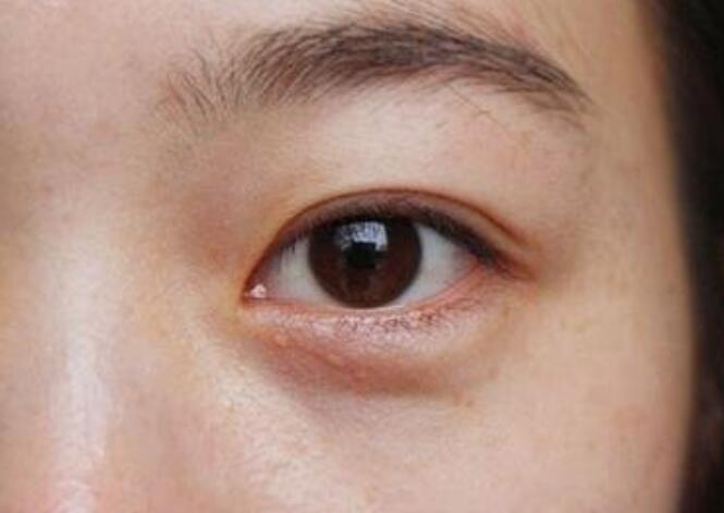 黑眼圈的種類有哪些？廣西美容培訓(xùn)教你保養(yǎng)