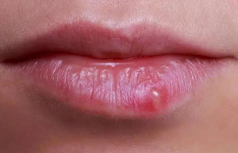 紋唇后起泡怎么辦？南寧紋唇培訓學校教你方法
