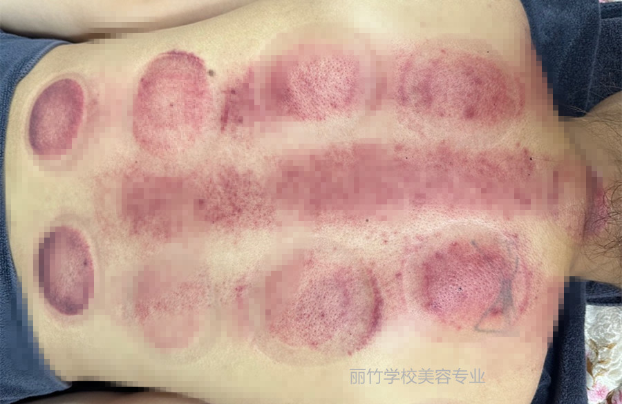 拔火罐的顏色代表什么？南寧美容美體專業(yè)實訓