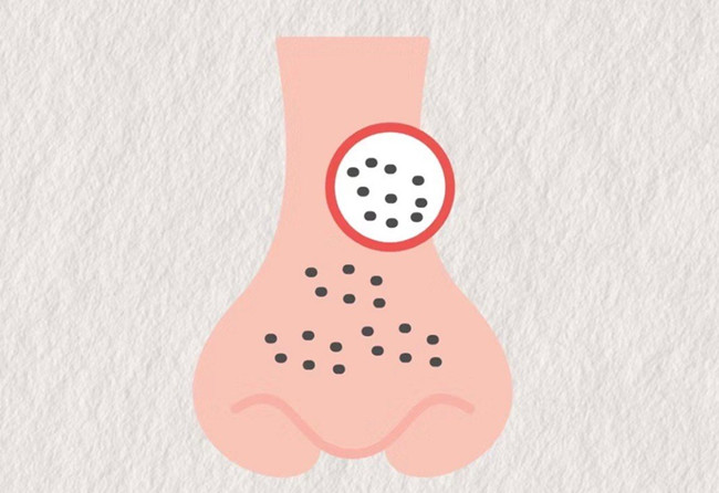 廣西皮膚管理師：面對嚴重的黑頭應(yīng)該怎么辦？